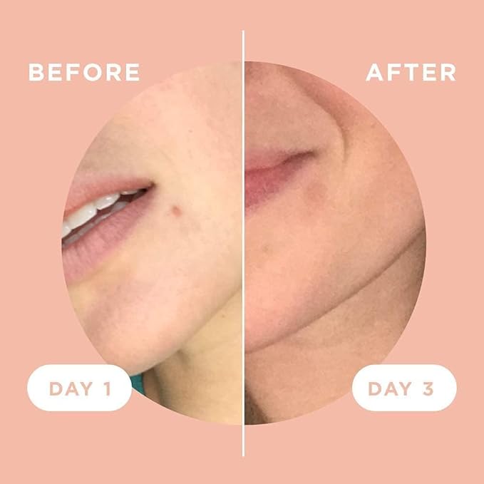 ZitSticka Killa Acne Patches for Face - World's Most Potent Pimple Patch with Fast-Acting Microdarts - Starts Working within 2 Hours for Deep, Early-Stage Zits & Blemish - 4 Count