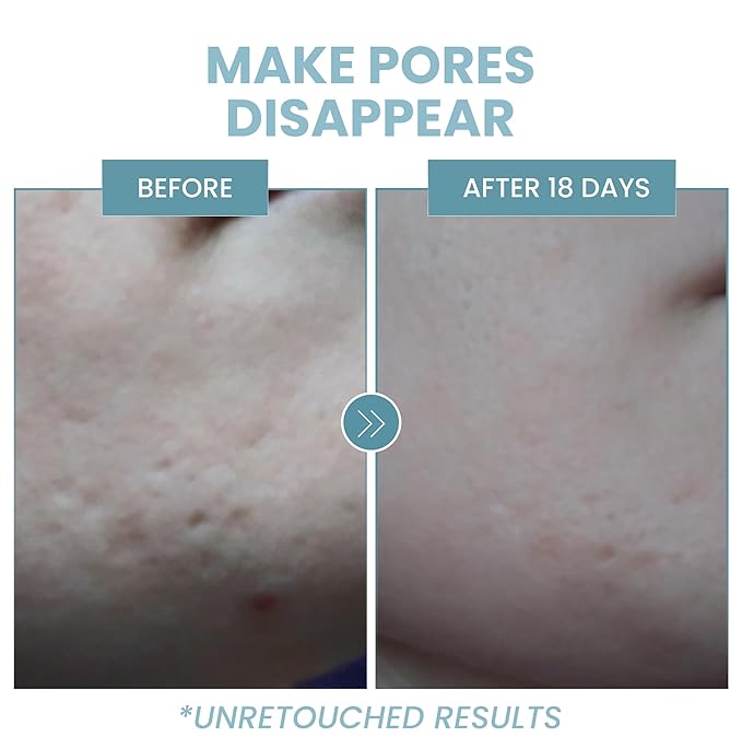 Eva Naturals Niacinamide 5% Serum for Face – B3 Pore Minimizer, Acne Treatment & Dark Spot Corrector with Hyaluronic Acid, Vitamin E, Aloe & Neem – Anti-Aging, Non-Greasy, Hydrating, 2oz