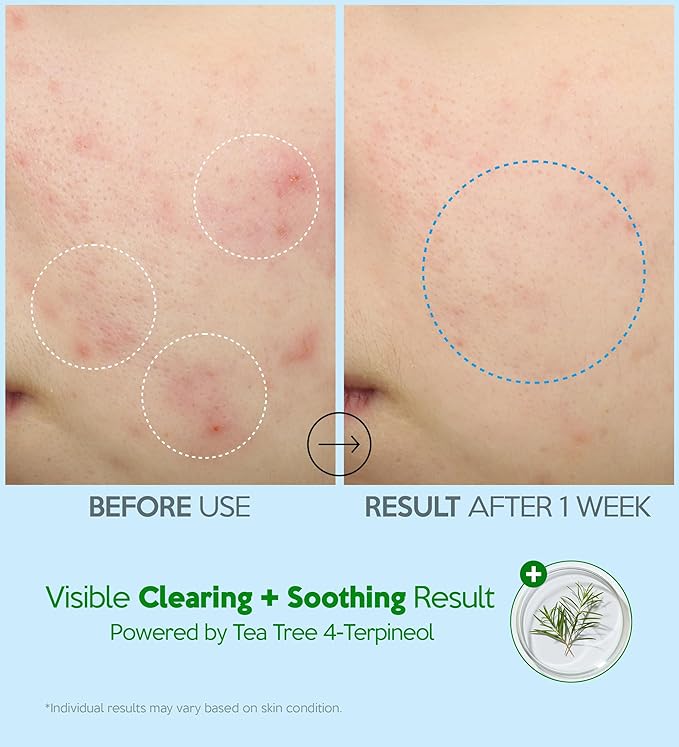 Troubless Hydro Soothing Moisture Cream - Deep Hydration & Skin Barrier Cream for Face w/ 10,000 ppm Panthenol & Tea Tree 4-Terpineol - Soothing & Non-Greasy Face Moisturizer (2.36 fl oz)