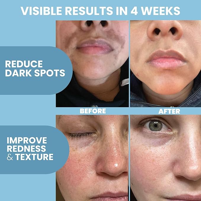 Eva Naturals Azelaic Acid Serum for Face – Niacinamide, Hyaluronic Acid, Vitamins A+C+E – Redness Relief, Dark Spots, Uneven Skin Tone, Texture, Pores, Topical Booster for Clearer, Smoother Skin, 2oz