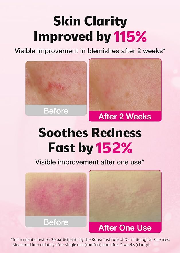 ISOI Blemish Care Up Serum for Face, Vegan Hydrating Serum for Smooth & Glass Skin Effect, Skin Barrier & Moisture Balance for Women, Arbutin, Korean Skin Care (2.36 fl. oz, 70ml)