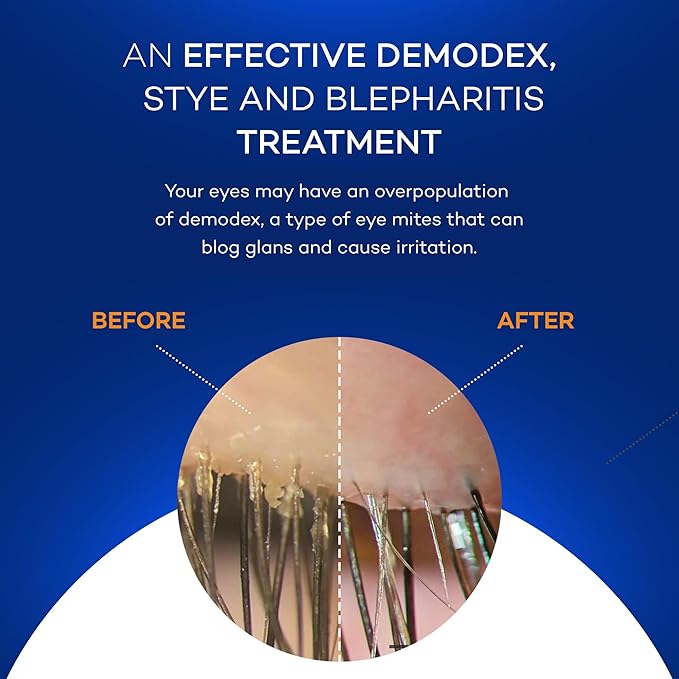 Zocuwipe Eyelid Wipes with Natural Okra Complex - Eyelid Cleanser and Moisturizer Pads - Eyelid Cleansing Wipes - Blepharitis Treatment - 15ct