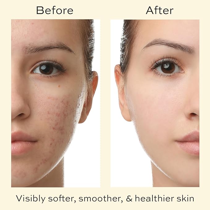 Skin Care for Teenage Boys and Girls - Teen Moisturizer for Face with Tea Tree - Organic Face Cream for Oily Skin - Daily Acne Treatment for Teenagers - Soothing Hyaluronic Acid Moisturizer