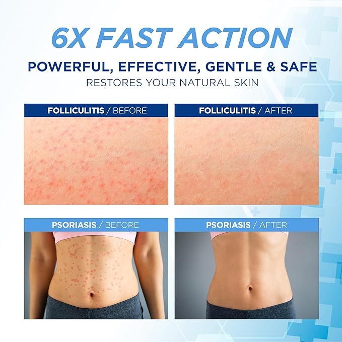 Folliculitis Treatment Cream: Effective Treatment for Folliculitis Scalp Face and Body 100g