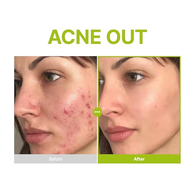 PURITO Azelaic Acid 10% + Kojic Acid + Tea Tree Facial Serum | for Acne & Marks, Breakouts | High-Level Azelaic Acid 10% | Korean skincare, 30mL 1.01 fl.oz