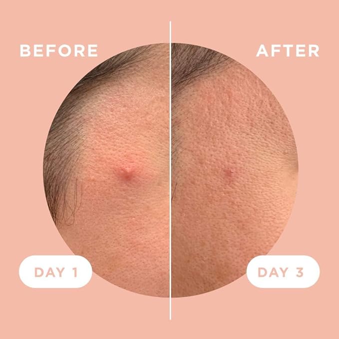 ZitSticka Killa Acne Patches for Face - World's Most Potent Pimple Patch with Fast-Acting Microdarts - Starts Working within 2 Hours for Deep, Early-Stage Zits & Blemish - 4 Count