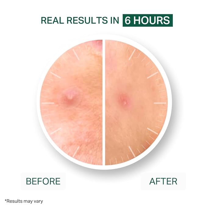 Y’OUR Essential Acne Treatment Duo: Spot Treatment & Healing Patches; Pimple Clearing, Pore Minimizing Skincare. Made in USA. Basic Routine for All Skin Types