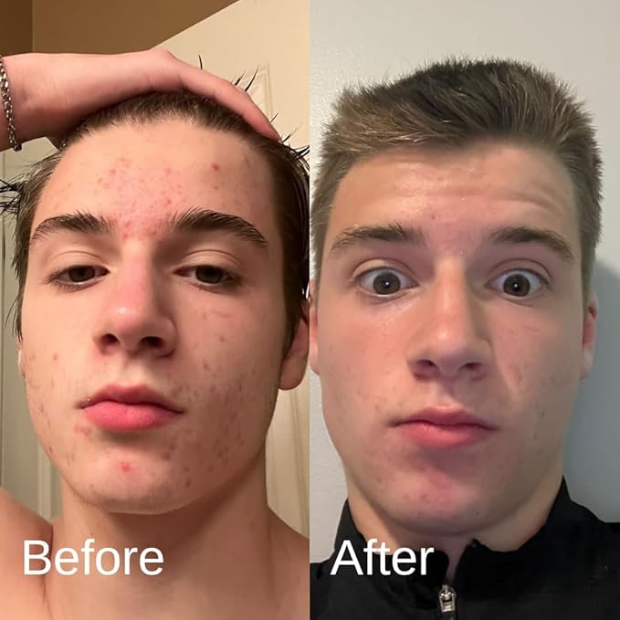 Acne System for Men and Boys, Face Wash, Moisturizer, Pimple Patches, Shield Men's Skin Care Set (1 Month)