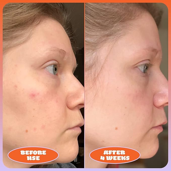 Blume Milky Fade Vitamin C Serum for Face - Dark Spot Corrector with Niacinamide, Hyaluronic Acid & Vitamin E - Helps to Soothe Skin Tone - Vegan & Cruelty-Free Hydrating Serum (1 oz)