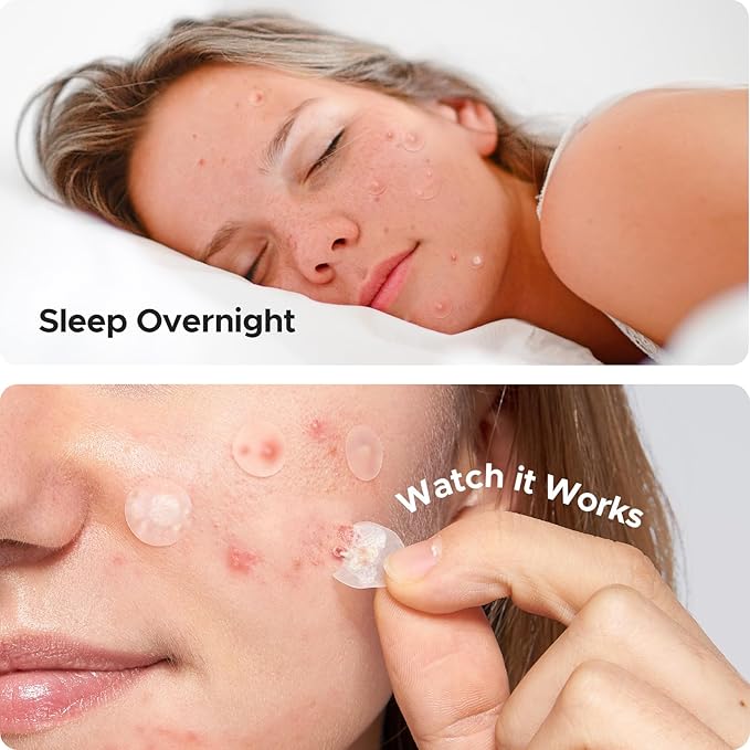 TKTK Hydrocolloid Acne Patches, Pimple Patches for Face with Tea Tree & Calendula Oil - 4 Sizes Clear Cover Stickers, Invisible for Day & Night Use (180 Count)