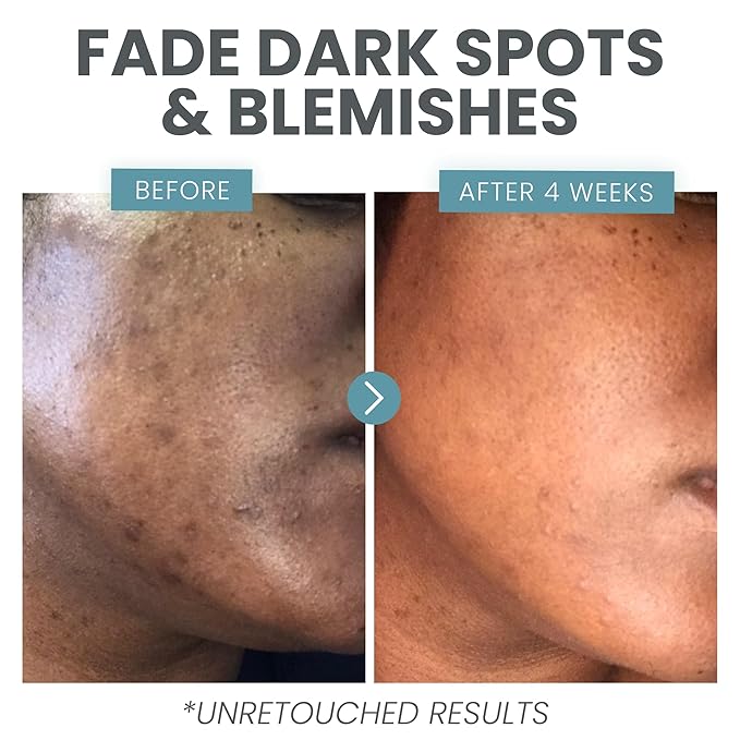 Vitamin C Serum for Face with Retinol & Salicylic Acid – Skin Clearing Acne Spot Treatment with Niacinamide, Hyaluronic Acid, MSM – Anti-Aging Facial Serum for Dark Spots and Blemishes