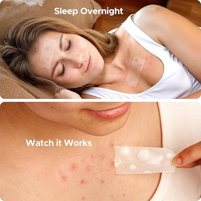 TKTK Large Pimple Patches for Face, 68 x 27 mm XL Hydrocolloid Bandages, Big Acne Patches for Body, Forehead, Chin, Nose, Chest and Back Blemish Zit Breakouts (Strip, Contoured, Dot 5 Sizes 295 Count)