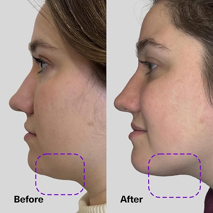 SickScience ShapeShift Advanced Jaw & Neck Firming Serum - Double Chin Reducer, Face Tightening Treatment with Exosome Technology to Lift Sagging Skin & Wrinkles in both Women & Men, 1.7oz