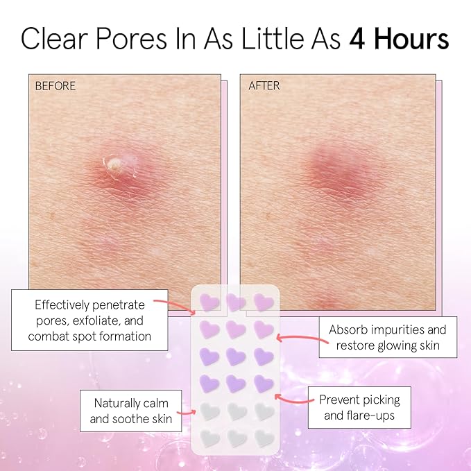 grace & stella Award Winning Pore Strip - Pimple Patches for Face - Heart Hydrocolloid Zit Stickers that Help Soothe & Conceal Breakouts - Cute Patches - Dermatologist-Tested, Vegan (Heart, 72 Count)