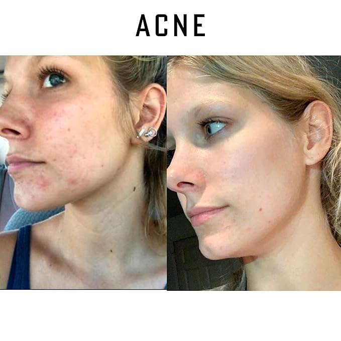 Pure Organic Ozonated Olive Oil Extra Strength 1200 Peroxide For Face and Skin Helps In Acne, Anti-Aging, Wrinkles and Rosacea For Sensitive Skin Made in Spain