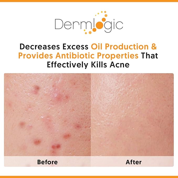 Acne Face & Body Cream- Maximum Strength Treatment for Cystic, Blackhead & Whitehead Pimples. Prevents Future Breakouts.