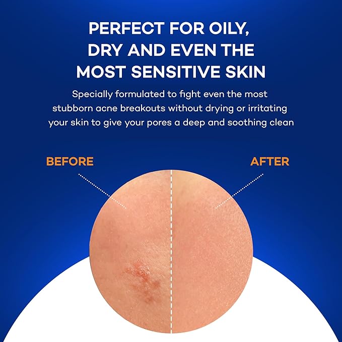 ZocuZap Acne Face Wipes - Moisturizing Face Cleansing Wipes for Acne, Makeup Removal, and Exfoliation with Natural Okra Complex for Sensitive, Rosacea Skin - 30/ct