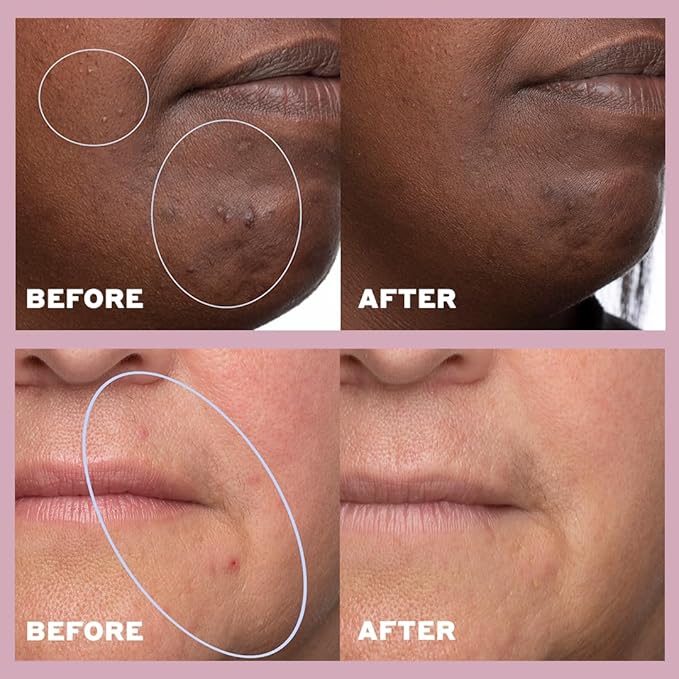 Volition Beauty Skin Rhythm Balancing & Cleaning Serum with Niacinamide + Salicylic Acid | Acne & Blemish Treatment | Helps Even Skin Tone, Fade Dark Spots, Reduce Acne Scars