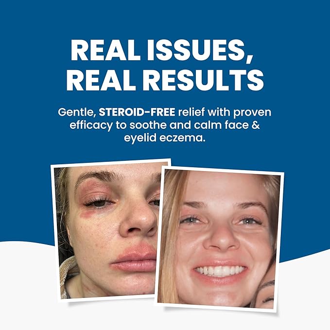 Grahams Natural Face & Eyelid Eczema Relief Kit - Treatment for Dry Skin, Eczema, Perioral & Seborrheic Dermatitis | Itch Relief - Moisturizing Face Cream (1.76 fl oz) + Eyelid Oil (1.69 fl oz)