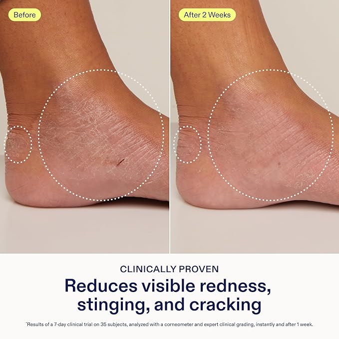 Skinfix Hand Relief Cream - 3 fl oz - Reduces Visible Redness, Stinging & Cracking for Dry, Sensitive Skin - Accepted by the National Eczema Association - Fragrance Free - Vegan, Cruelty Free