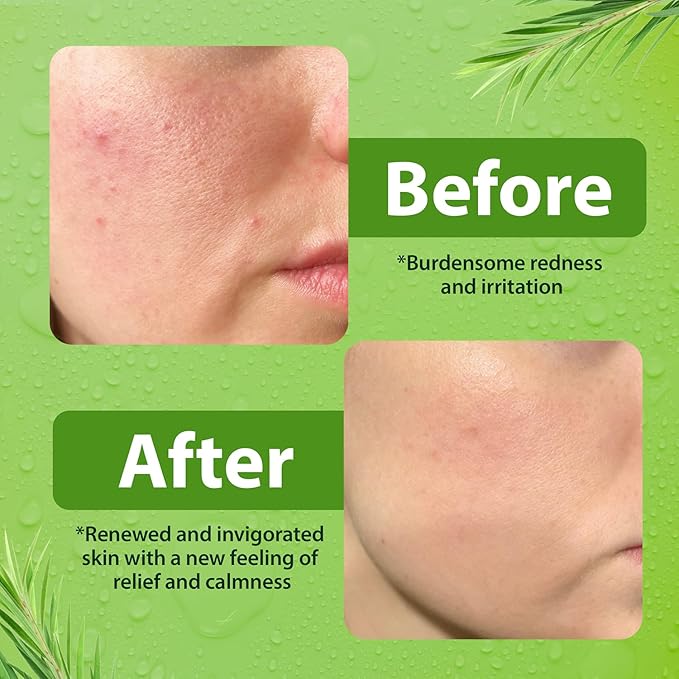 Gentle Face Wash for Men & Women – Hydrating Facial Cleanser for Eczema, Psoriasis & Sensitive Skin – Fights Redness, Oil & Breakouts – pH-Balanced & Perfect for Oily, Blemish-Prone Skin – 8oz