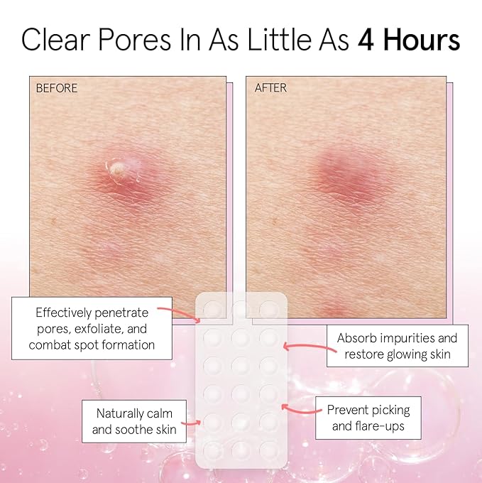 grace & stella Award Winning Pore Strip Pimple Patches for Face - Hydrocolloid Acne Patches for Shrinking Zits, Whiteheads - Spot Stickers - Dermatologist-Tested, Vegan (Invisible, 72 Count)