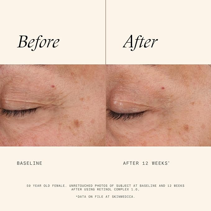 SkinMedica Retinol 1.0 Complex - Retinol Serum for Face, Age-Defying Advanced Retinol Cream That Renews Skin and Diminishes the Appearance of Fine Lines and Wrinkles, 1 Fl Oz