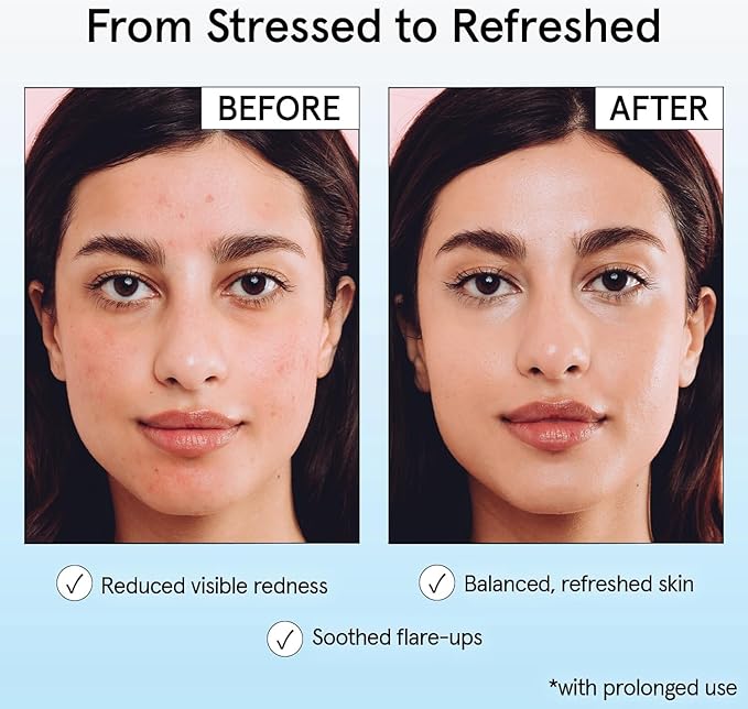 grace & stella Hypochlorous Acid Spray for Face - Body Acne Spray - Gentle Face Mist to Calm Redness & Flare-Ups Back Acne - Soothing Facial Mist for Sensitive Skin - Travel Size (60 ml/2 fl oz)