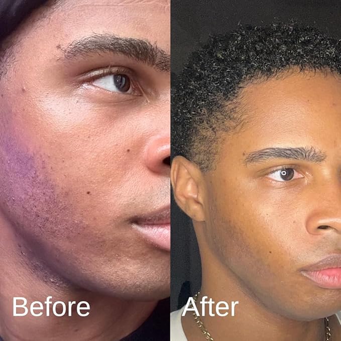 Acne System for Men and Boys, Face Wash, Moisturizer, Pimple Patches, Shield Men's Skin Care Set (1 Month)