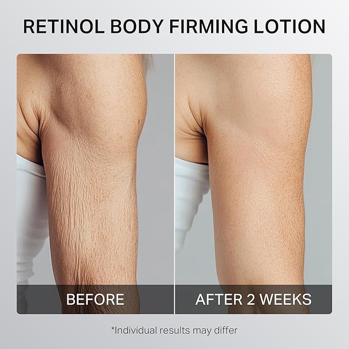 Ultra-Size Firming Retinol Body Lotion for Crepey Skin & Keratosis Pilaris with 0.05% Retinol, AHA, Collagen, Body Cream, Anti Aging Moisturizer 10.14 fl oz