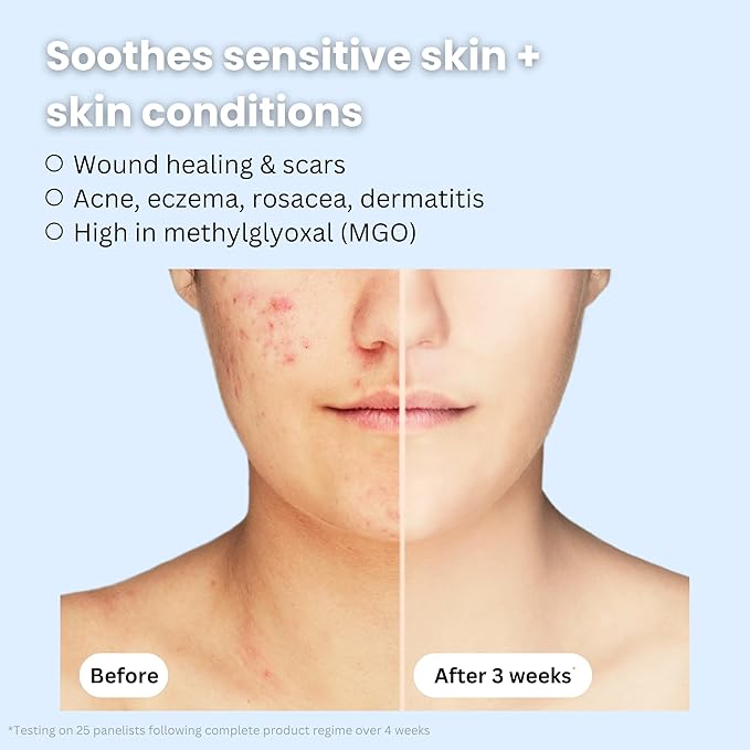 Organic Bee Venom + Manuka Day Barrier Face Moisturizer | Hydrating, Anti-Wrinkle, Collagen Booster | 2.5 month supply, 2oz/60ml | Made in New Zealand