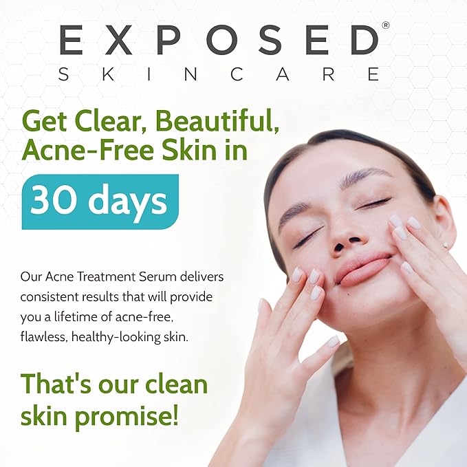Exposed Skin Care Acne Treatment Serum – Lightweight Acne Spot Treatment with Micro Benzoyl Peroxide, Green Tea & Tea Tree Oil, Quickly Clears Pimples and Breakouts, 2.7 Fl Oz