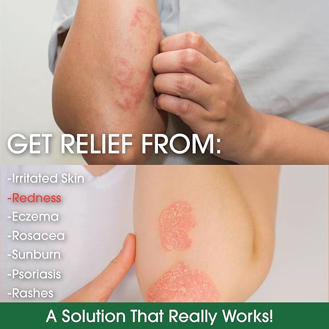 Green Leaf Naturals Manuka Honey Eczema Cream Moisturizing Lotion Fragrance Free for Psoriasis Relief - Itchy, Dry Skin Ointment - Skin Soothing Moisturizer - Body & Face Cream - Kids & Adults 4oz