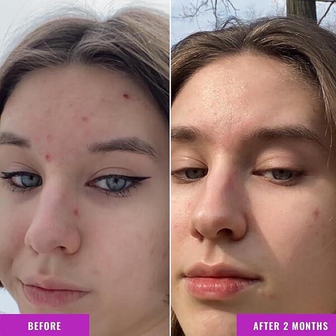 Good Molecules Niacinamide Serum - 10% Niacinamide to Target Acne, Nourishment, and Skin Tone - Ultra Hydrating Serum and Brightening Skin Care for Face