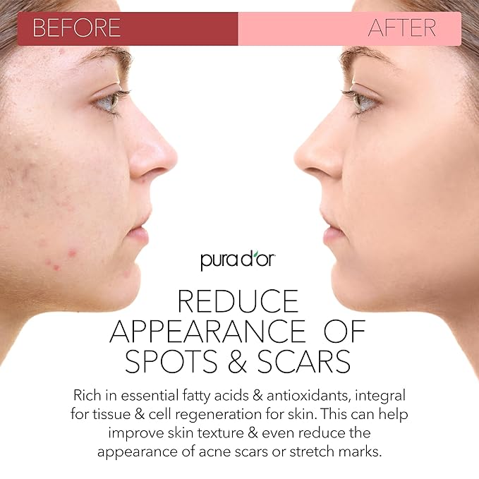 PURA D'OR 4 Oz ORGANIC Rosehip Seed Oil - 100% Pure Cold Pressed USDA Certified Anti-Aging Treatment - Vitamin A & C Rich - Helps Fade Appearance of Scars & Stretch Marks - For Face, Hair & Body