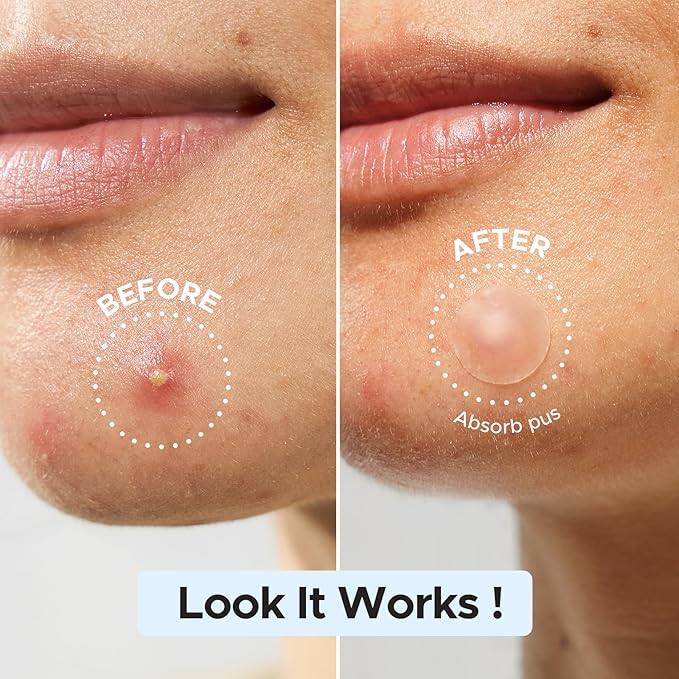 LitBear Pimple Patch Bulk, 480 Patches 3 Size Acne Patches for Face, Hydrocolloid Spot Stickers for Covering Zits, Blemishes, and Breakouts, Suitable for All Skin Types