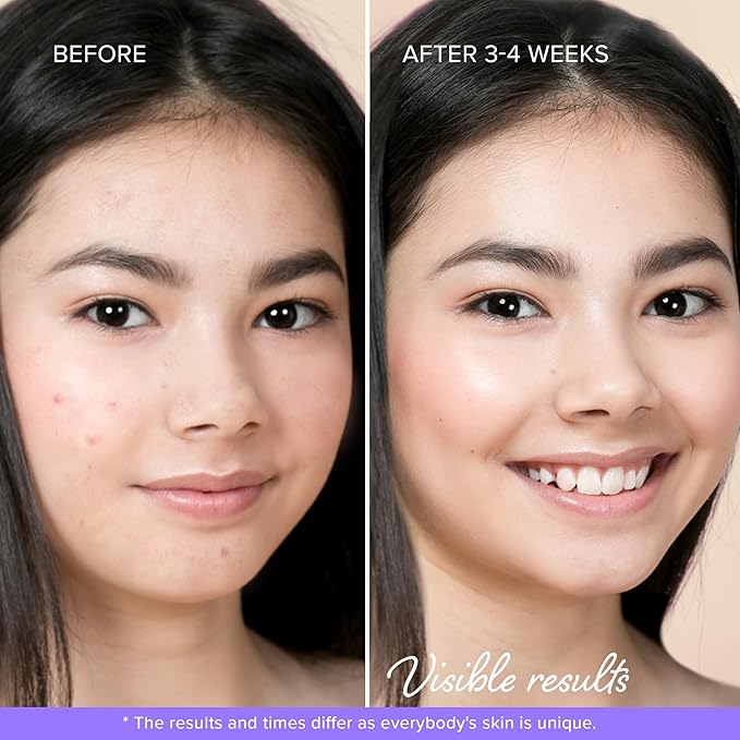 MAREE Star Pimple Patches for Face 2 PACK - Hydrocolloid Acne Patches w/Salicylic Acid, Tea Tree Oil & Centella - Cute Pimple Patches Stars - Teens Zit Patches Stickers - Parches Para Acne - 144 Dots