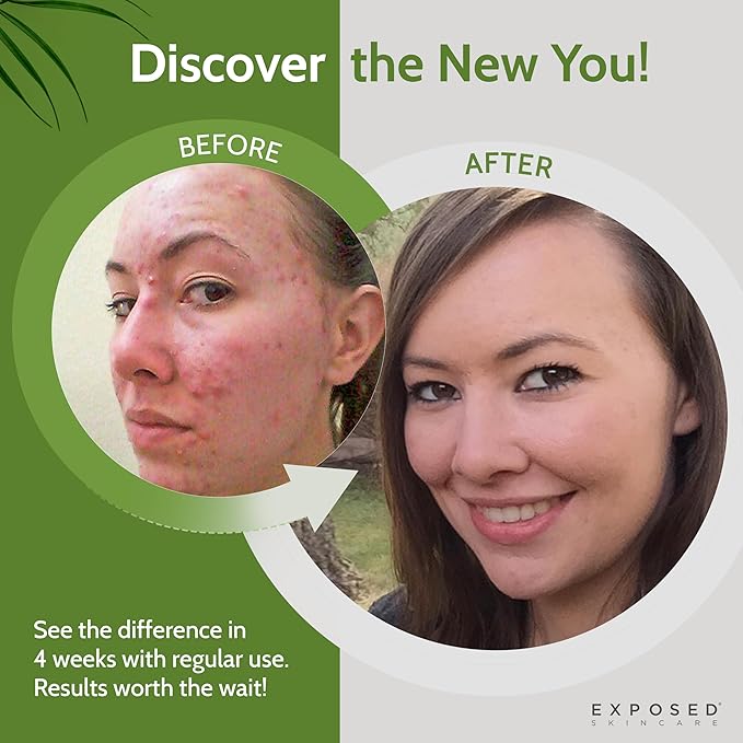 Exposed Skin Care, Acne Treatment Kit with 2.5% Salicylic Acid and 3.5% Benzoyl Peroxide to Clear Up Teen, Adult, Hormonal and Cystic Acne – Natural, Non-toxic and Cruelty Free