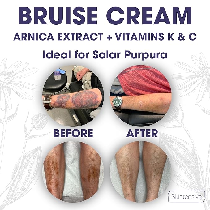 SKINTENSIVE Arnica Bruise Cream for Thin Skin - Moisturizing, Vitamin K C and E, Skin Renewal, 4 Oz
