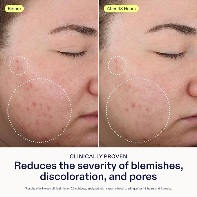 Skinfix 2% BHA Cleanser - 1 oz - Clears Acne Blemishes & Blackheads - Safe for All Types of Acne - Fragrance Free - Vegan, Cruelty Free