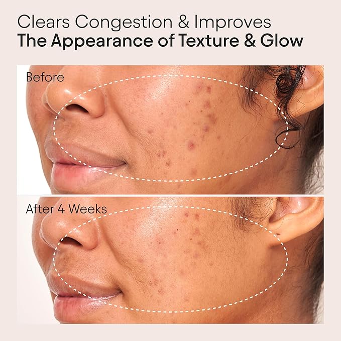 ALPYN Clarifying Facial Oil with Retinol & Pink Algae | Clear Congestion, Smooth Fine Lines, Improve Texture & Glow | 1 Fl Oz / 30 ml