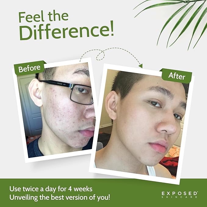 Exposed Skin Care, Acne Treatment Kit with 2.5% Salicylic Acid and 3.5% Benzoyl Peroxide to Clear Up Teen, Adult, Hormonal and Cystic Acne – Natural, Non-toxic and Cruelty Free