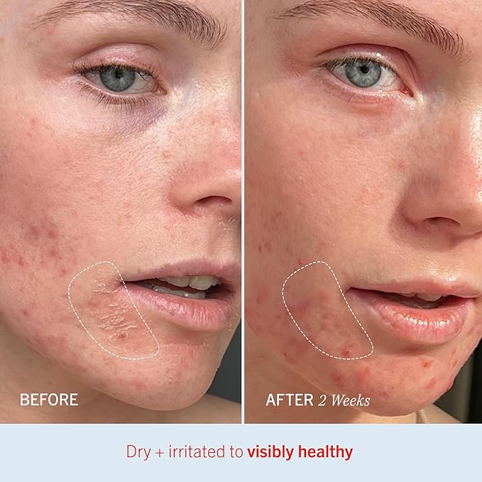 First Aid Beauty - Ultra Repair Cream, Intense Hydration Whipped Colloidal Oatmeal, Clinically Proven to Strengthen Skin Barrier in 7 Days + Helps Relieve Eczema, Luxury Moisturizer (6oz, 2ct)