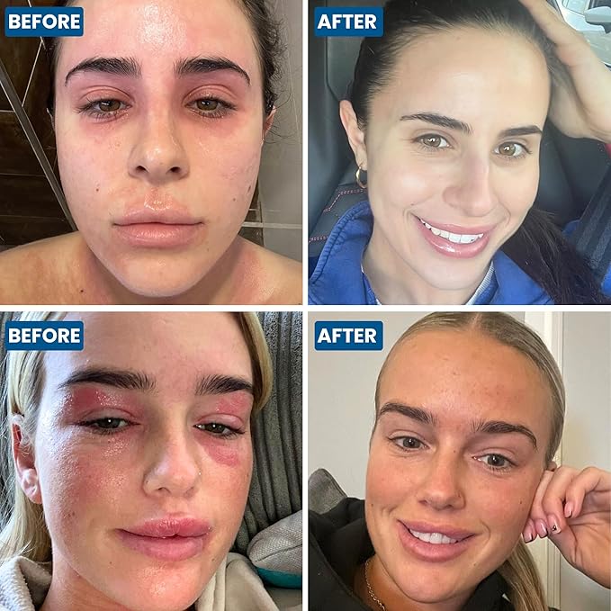 Grahams Natural Face & Eyelid Eczema Relief Kit - Treatment for Dry Skin, Eczema, Perioral & Seborrheic Dermatitis | Itch Relief - Moisturizing Face Cream (1.76 fl oz) + Eyelid Oil (1.69 fl oz)