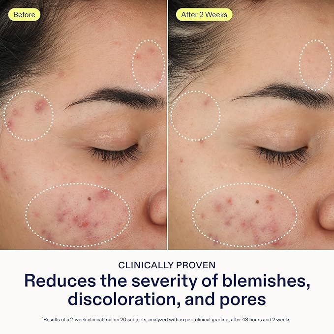 Skinfix 2% BHA Cleanser - 1 oz - Clears Acne Blemishes & Blackheads - Safe for All Types of Acne - Fragrance Free - Vegan, Cruelty Free