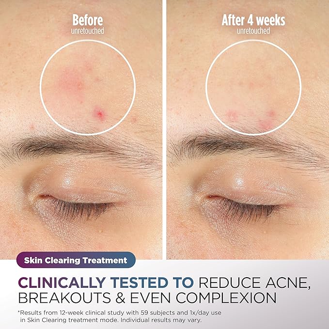 Shark CryoGlow LED Face Mask with Under-Eye Cooling, Anti-Ageing & Blemish Repair, Red & Blue LED, Infrared Light Therapy, USB-C, Remote Control, Storage Bag, Blue Frost, FW312